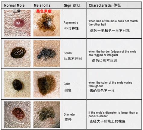 全身都是痣|为什么身上突然长出新痣？容易恶变吗？